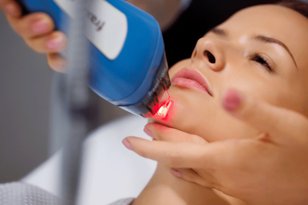 Laser αναζωογόνηση του δέρματος του προσώπου